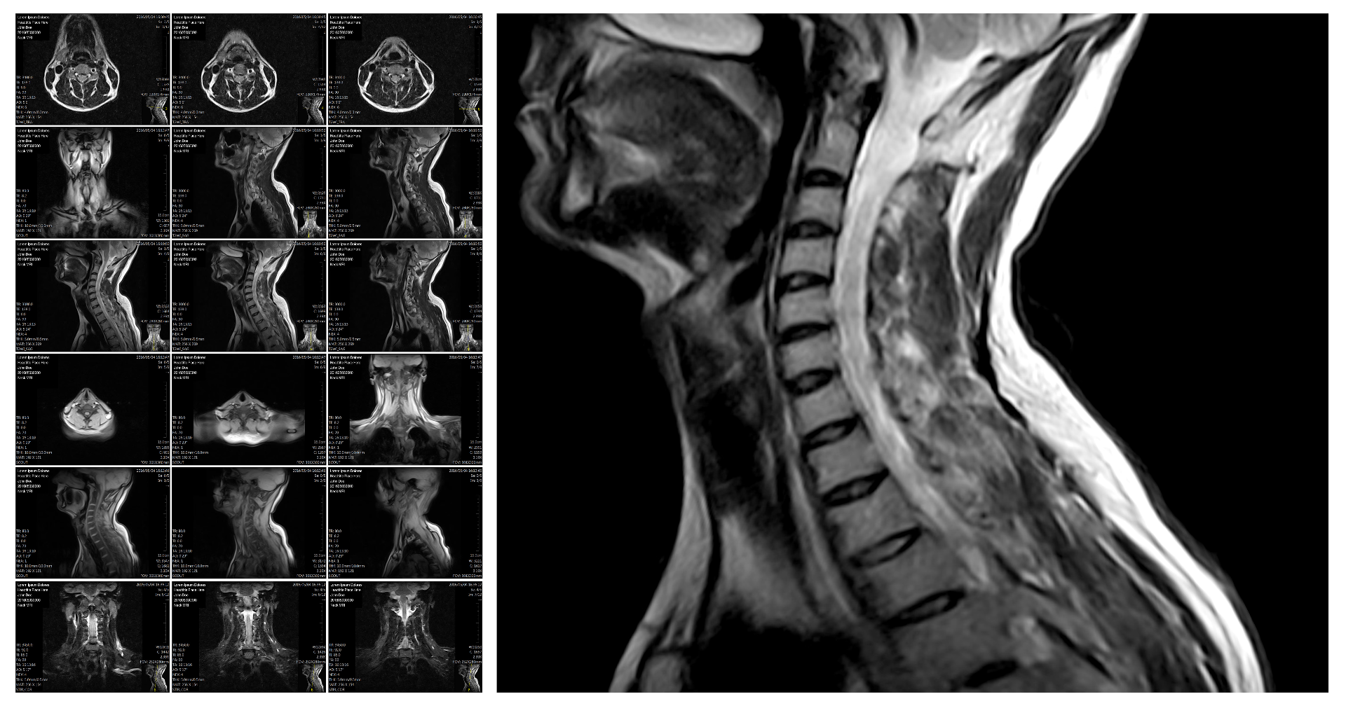 Cervical spine