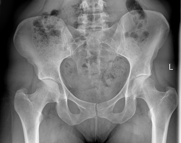 AP View — Pelvis & sacrum