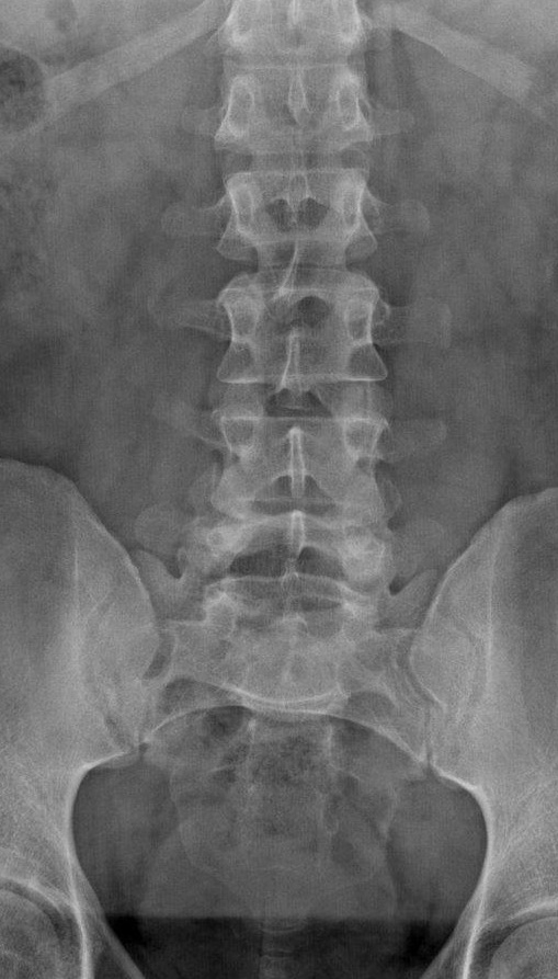 Lumbar X-Ray — Disc & alignment scan