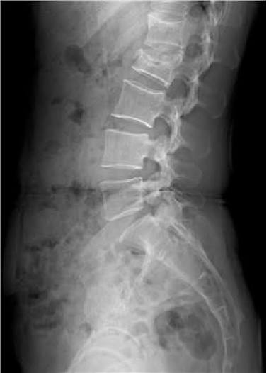 Lateral View — Lumbar curve study