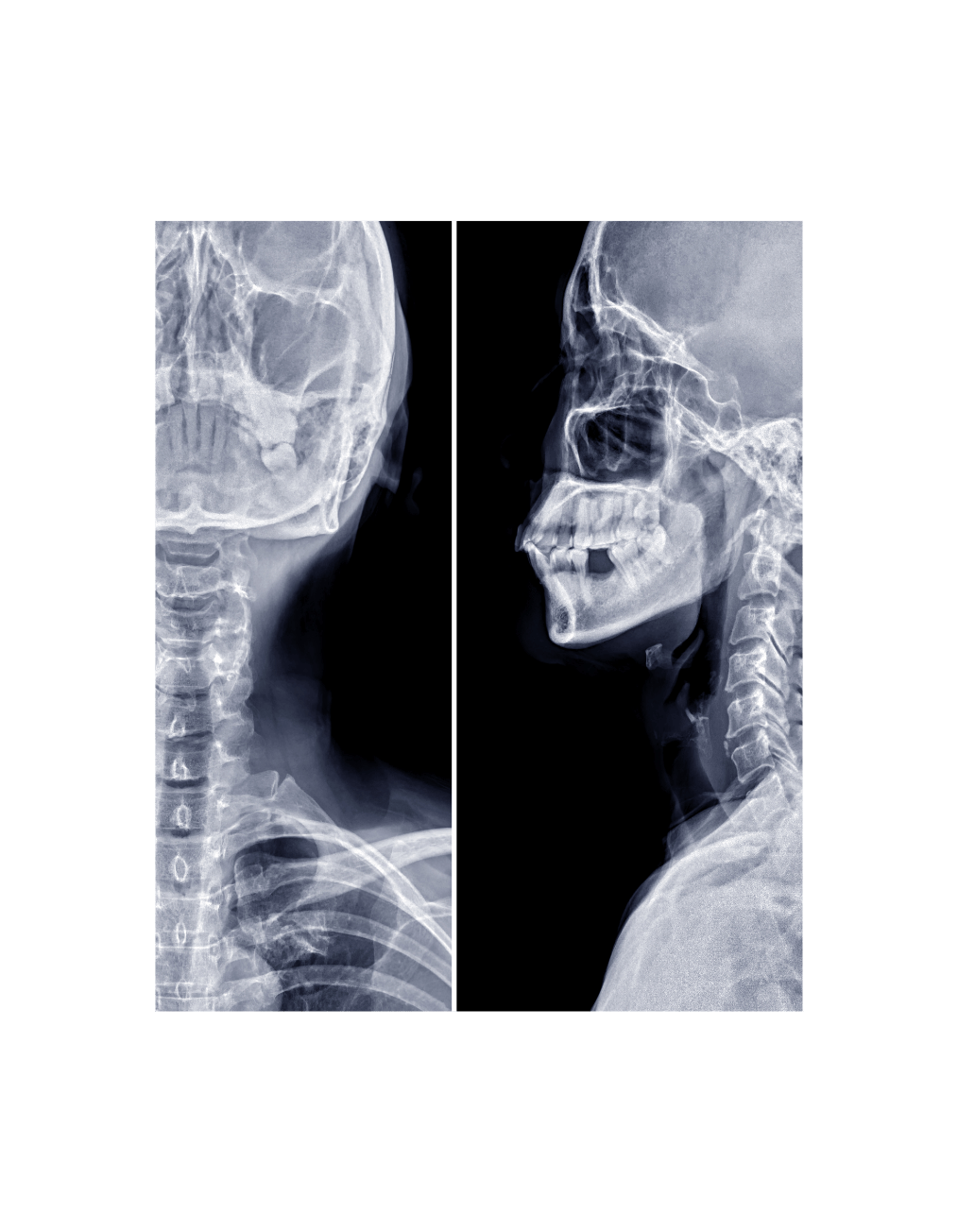 Lateral View — Spine assessment