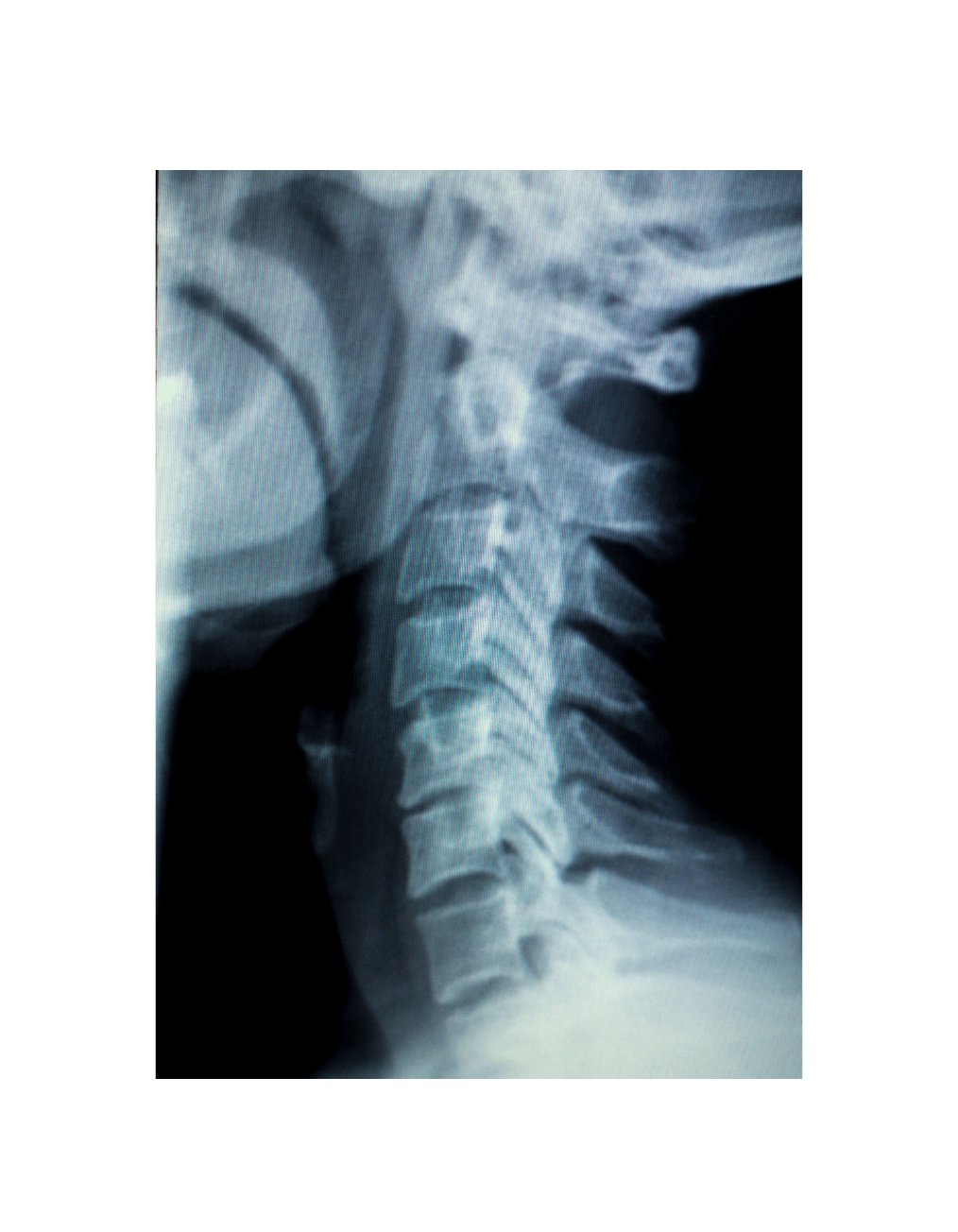 AP View — Cervical curve study